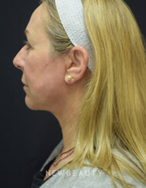 Dr. Jeffrey B. Wise - Facelift - After