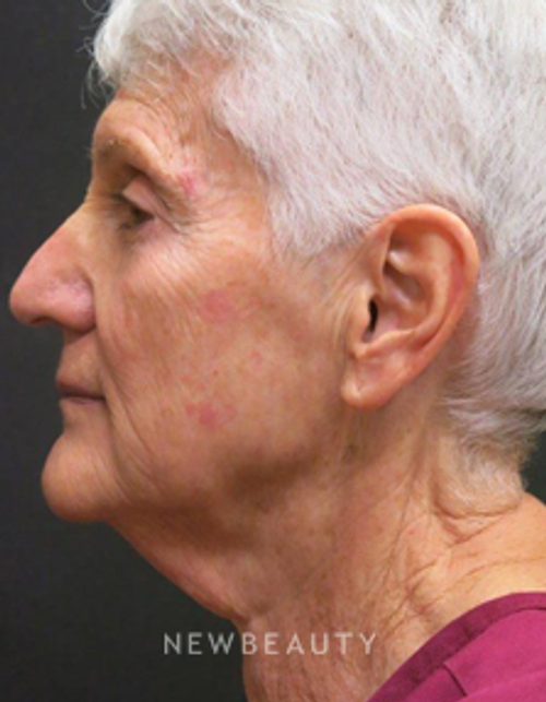 Dr. Elie Levine - Restoring Youthful Contours - Before