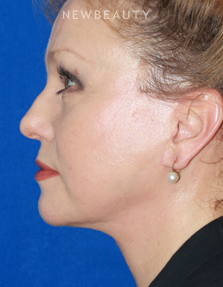Dr. Konstantin Vasyukevich - Facelift - After