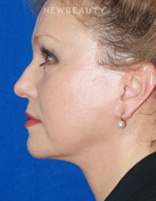 Dr. Konstantin Vasyukevich - Facelift - After
