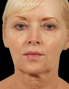 Dr. Kenneth Beer - Liquid Facelift - After