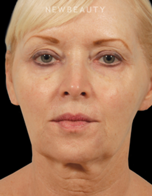 Dr. Kenneth Beer - Liquid Facelift - After