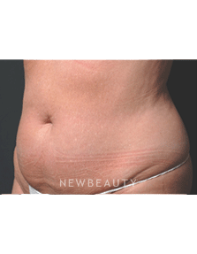 Dr. Ruth Hillelson Coolsculpting - After