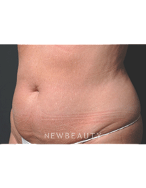 Dr. Ruth Hillelson Coolsculpting - After
