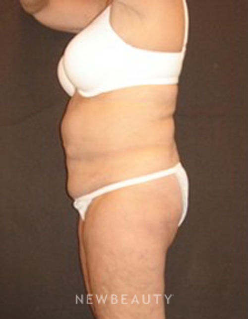 Dr. Joel Schlessinger - SmartLipo - Before