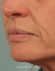 Dr. Kenneth Beer Injectables & Fillers, Juvederm - Before