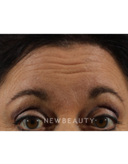 Dr. Marina Peredo - Botox - Before