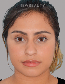 Dr. Anthony Bared - Refined Elegance - 44696946 - Before
