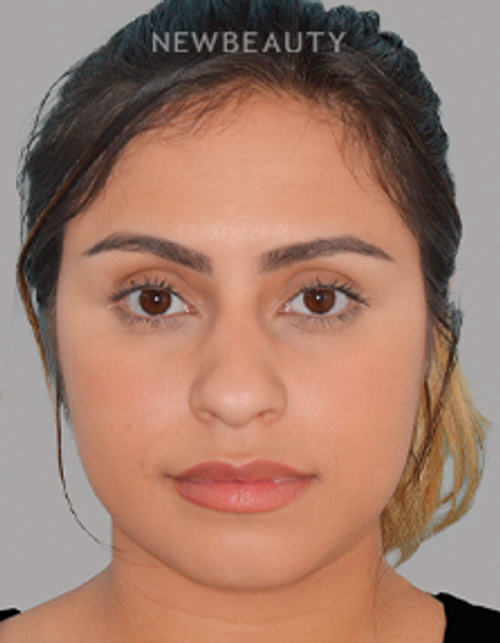 Dr. Anthony Bared - Refined Elegance - 44696946 - Before