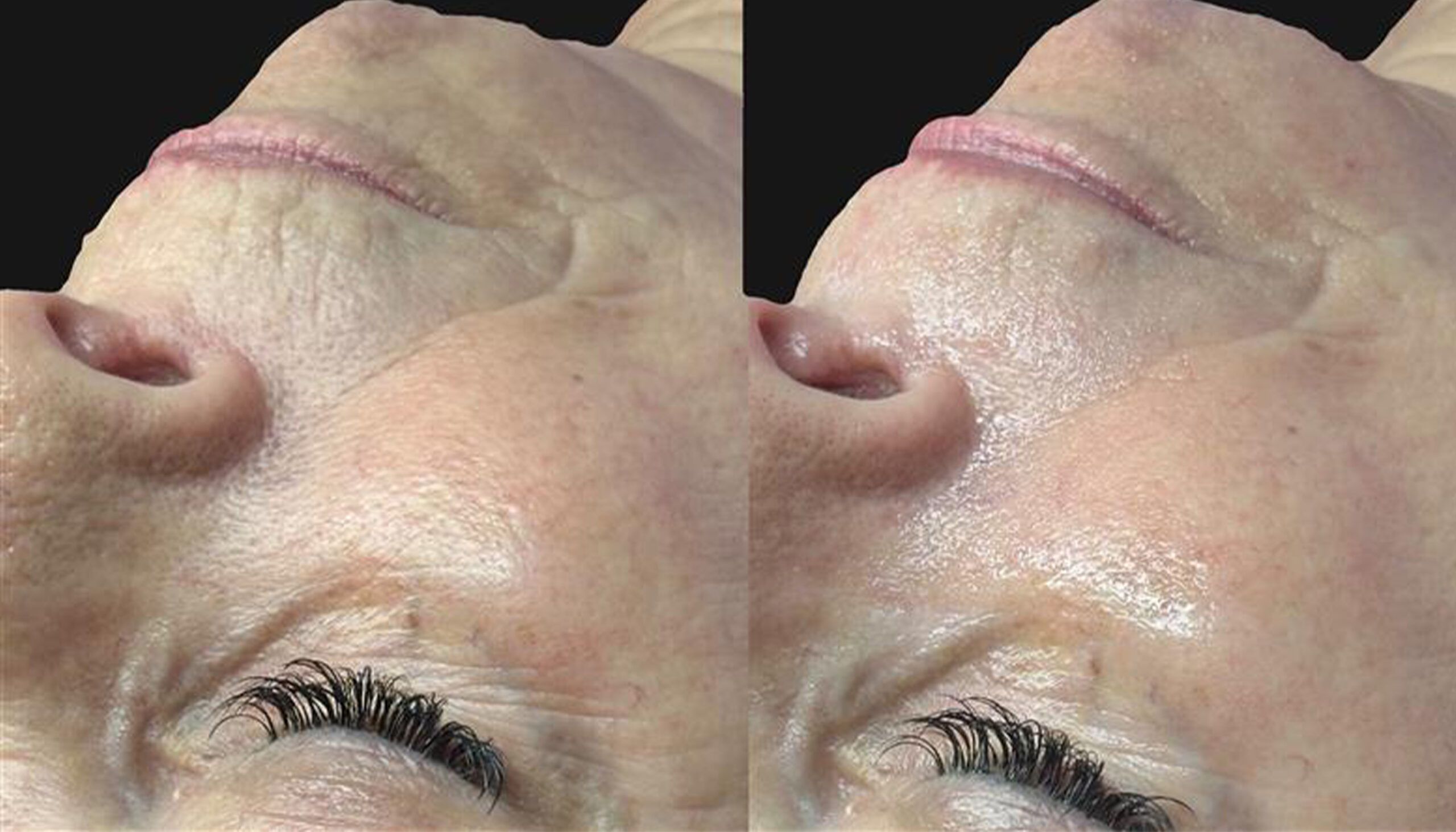 before and after Hydrafacial HydraFillic with Pep9 Booster