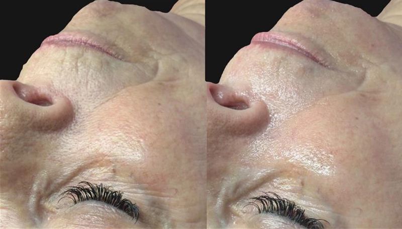 before and after Hydrafacial HydraFillic with Pep9 Booster
