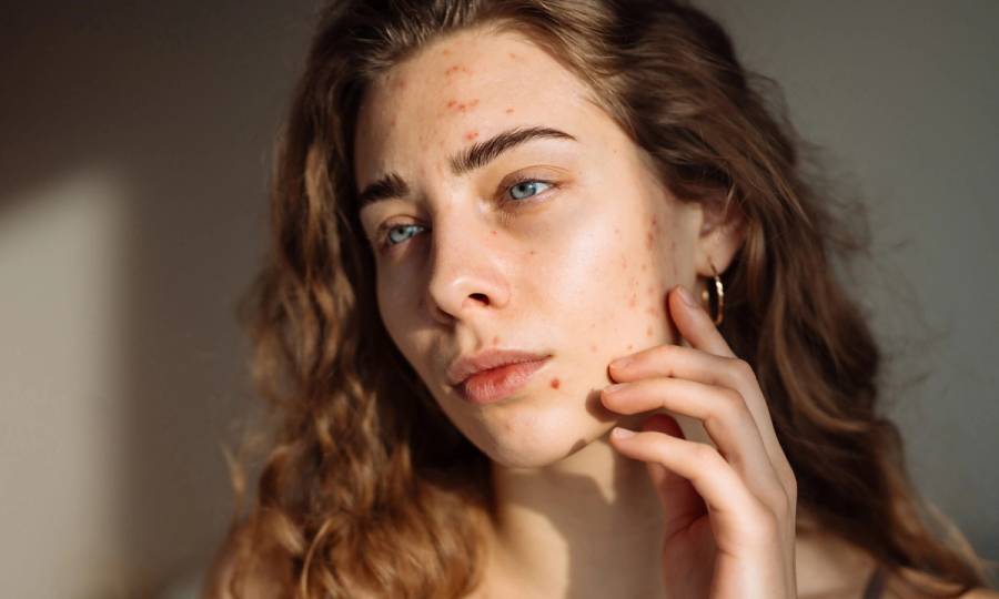 low-dose accutane