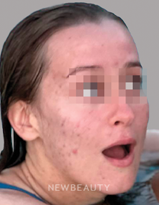 Dr. Anna Chacon - Acne - 34291048 - Before
