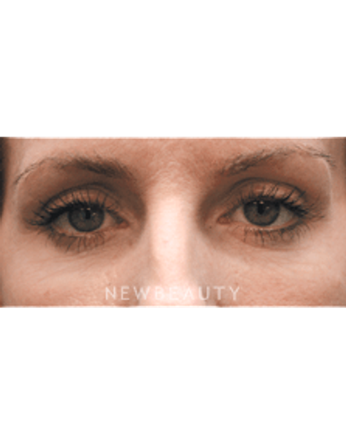 Dr. Christine Hamori Liquid Lift, Belotero, Juvederm - Before