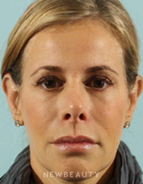 Dr. Marina Peredo - Sculptra - After