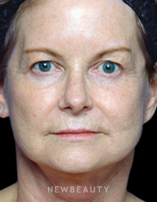 Dr. Alan Durkin - Upper Blepharoplasty - After