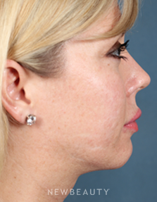 Dr. Bradley Calobrace Lasers - Before