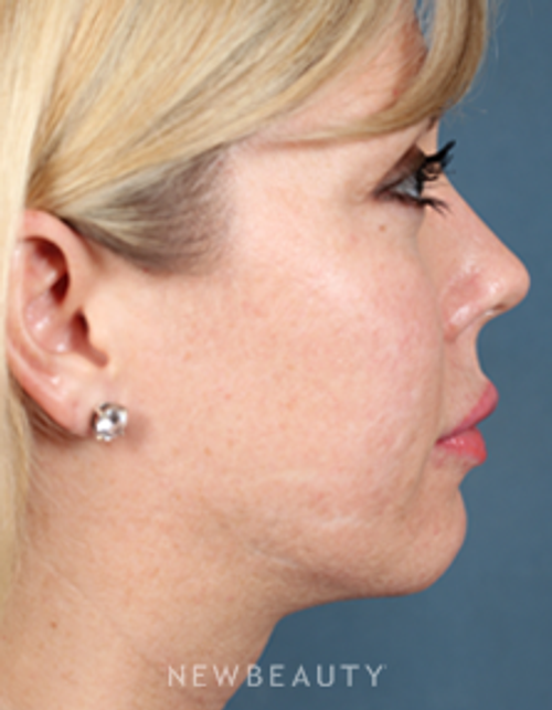 Dr. Bradley Calobrace Lasers - Before