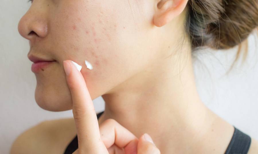 head and shoulders for acne