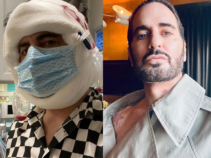 Marc Jacobs Shares Results of a Recent Facelift That Uses This Special Technique