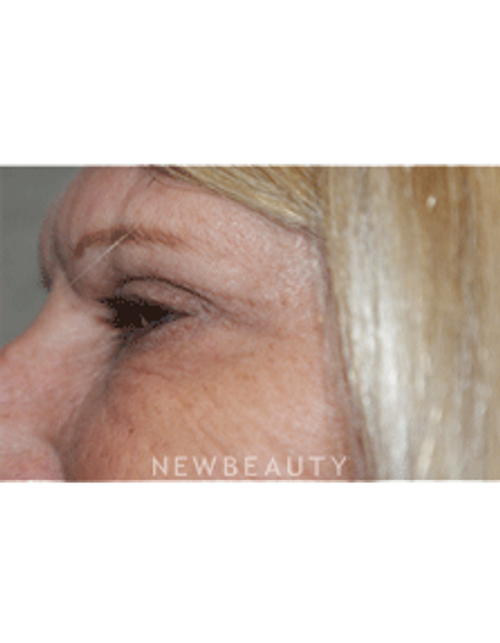 Dr. Marina Peredo Elos Injections/Liquid Lift - After
