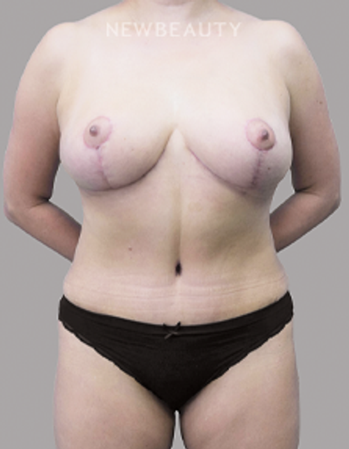 Dr. Olga Bachilo - Mommy Makeover - 28650984 - After