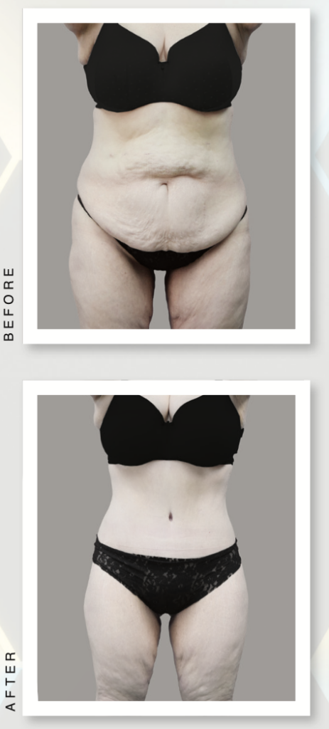 full lower bodylift before and after