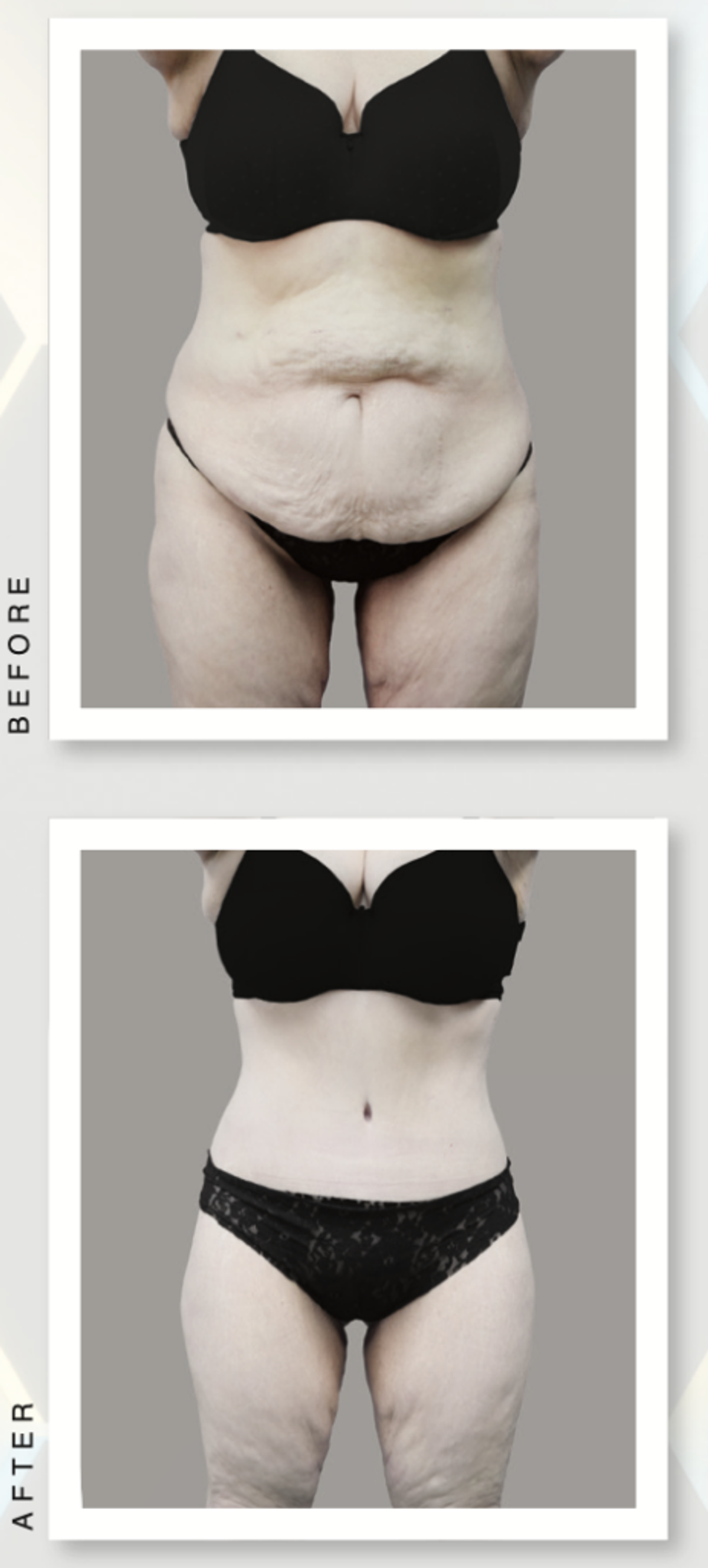 full lower bodylift before and after