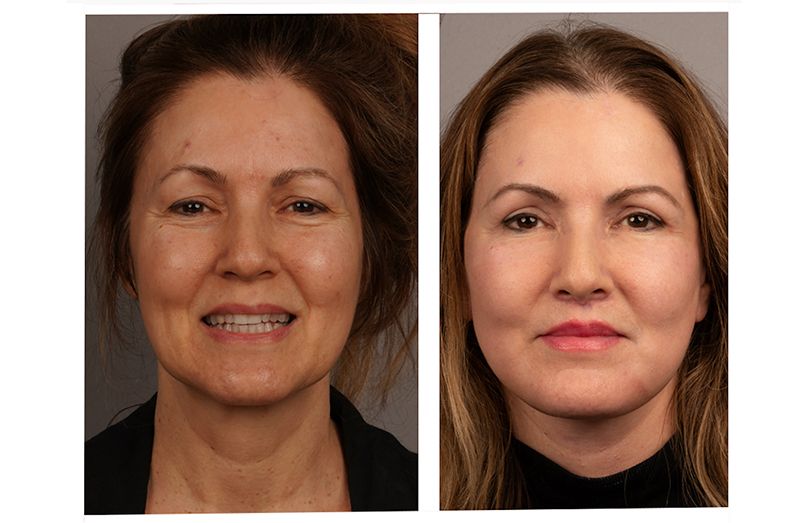 Becca underwent a deep plane facelift, neck lift, upper blepharoplasty, lip lift and chemical peel to restore balance and brightness to her face.