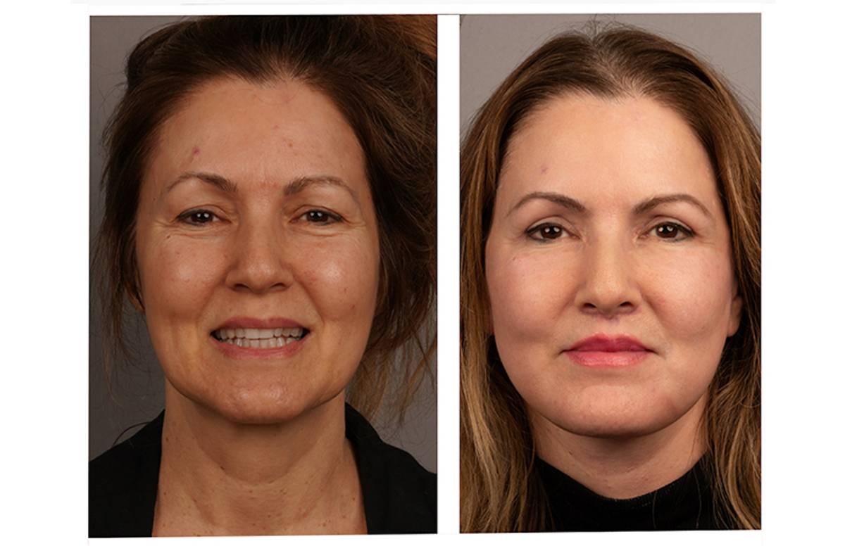 Becca underwent a deep plane facelift, neck lift, upper blepharoplasty, lip lift and chemical peel to restore balance and brightness to her face.