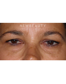 Dr. George Sanders - Eyelift - Before