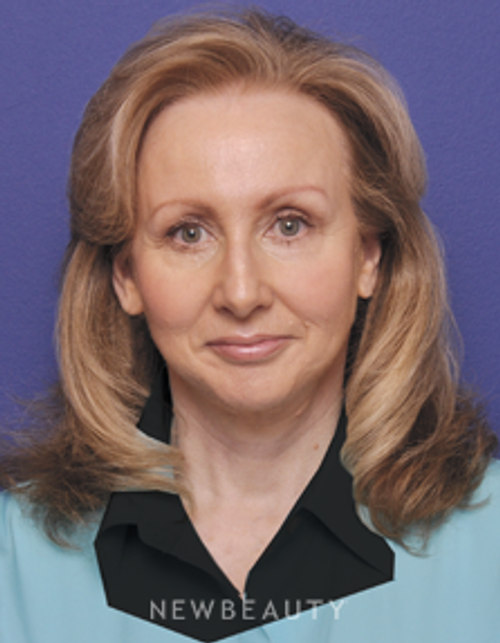 Dr. Alan Durkin Facelift, Blepharoplasty - After