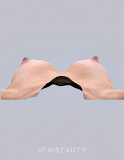 Dr. Bradley Bengtson - Vectra 3D Imaging - After
