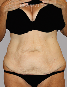 Dr. Lily Lee - Tummy Tuck - 46336045 - Before