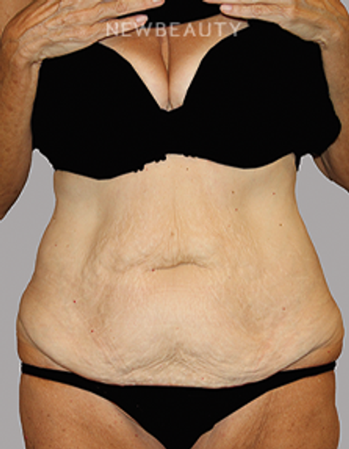 Dr. Lily Lee - Tummy Tuck - 46336045 - Before