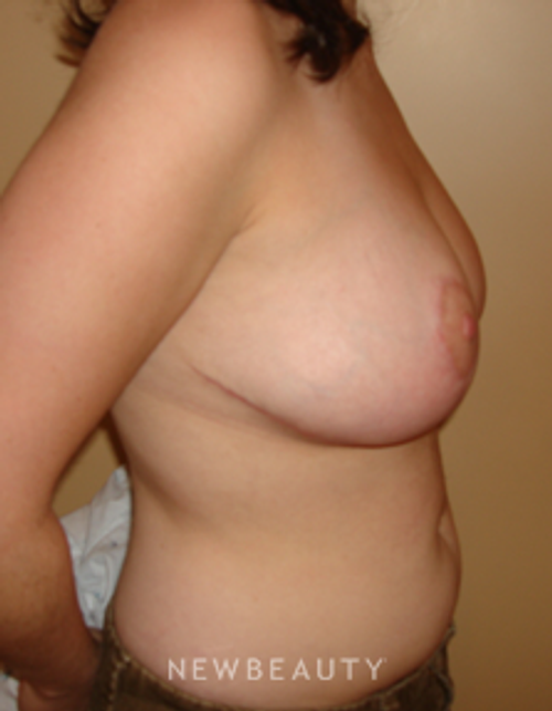 Dr. Michael Horn Breast Reduction - After