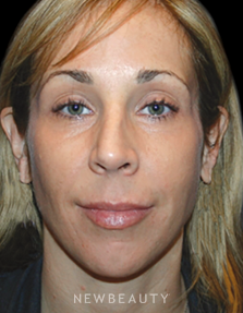 Dr. Kelly Bomer - Liquid Facelift - Before