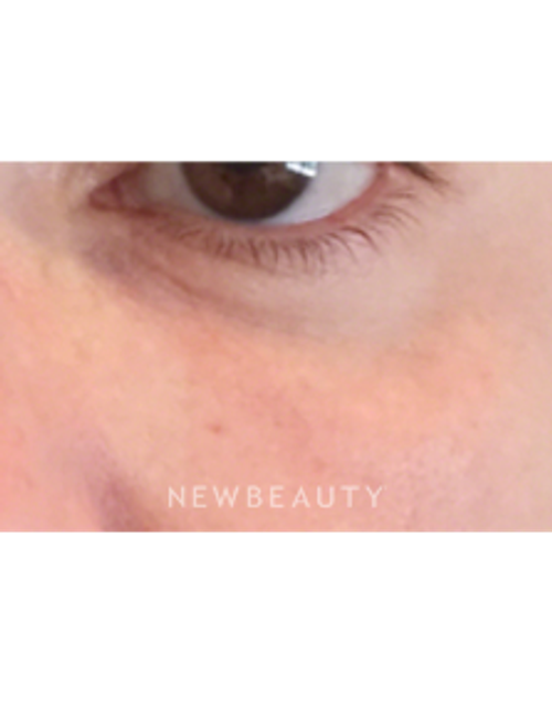 Dr. Kally Papantoniou - Injectables and Fillers - After
