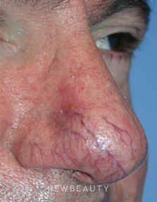 Dr. Kelly Bomer, Spider Vein Treatment - Before