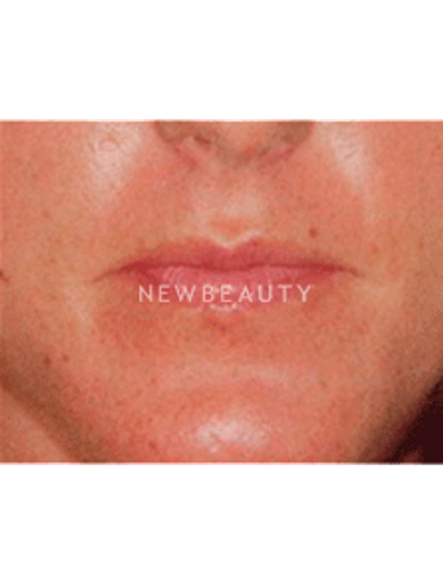 Dr. Christine Hamori Lip Augmentation - Before