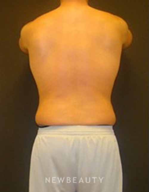 Dr. Joel Schlessinger - SmartLipo - Before