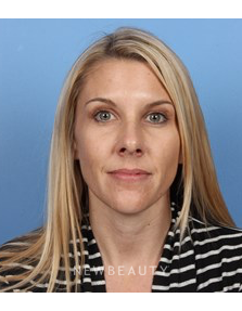 Dr. Kelly Bomer - Dysport - After