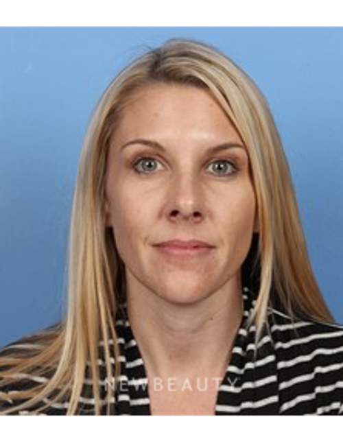 Dr. Kelly Bomer - Dysport - After