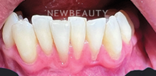 Dr. Hamid Atabakhsh – Smile Makeover - 46510405 - Before
