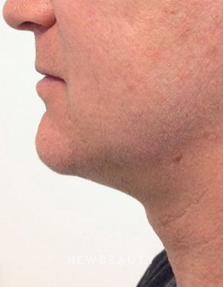 Dr. Julie Russak - Ultherapy - After