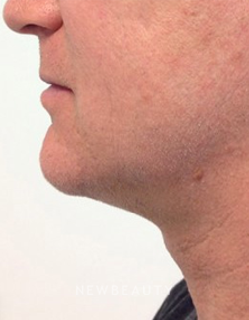 Dr. Julie Russak - Ultherapy - After