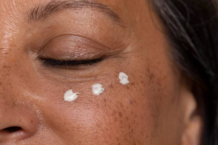 Three dabs of white eye cream on a woman’s freckled cheek beneath her closed eye.