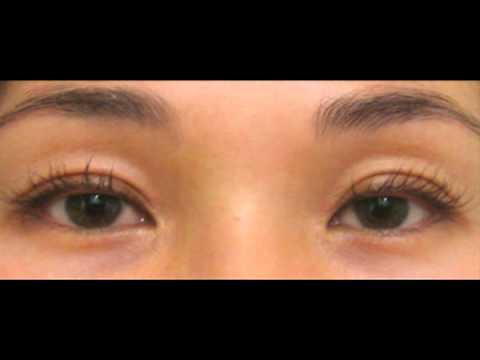 Dr. Fitzgerald – Watch Lashes Grow Before Your Eyes – Latisse At Dr. Rebecca Fitzgerald’s Office