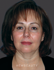 Dr. Mary Herte Facelift, Eyelift - Before