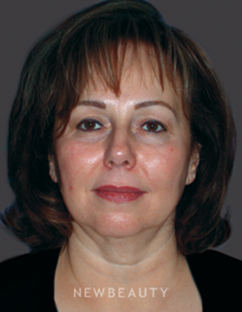 Dr. Mary Herte Facelift, Eyelift - Before